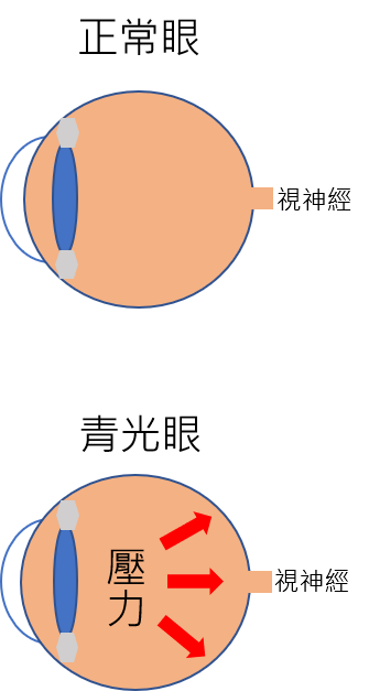 青光眼(Glaucoma)簡介