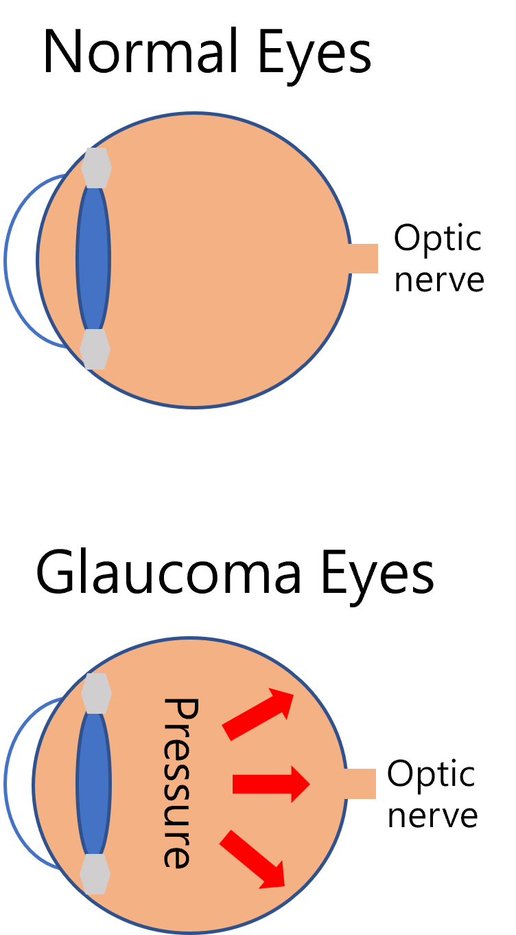 青光眼(Glaucoma)簡介