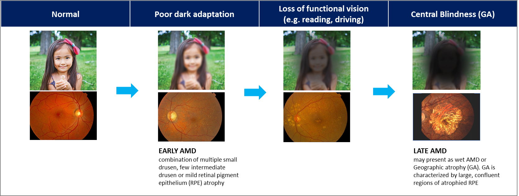 Geographic Atrophy, GA