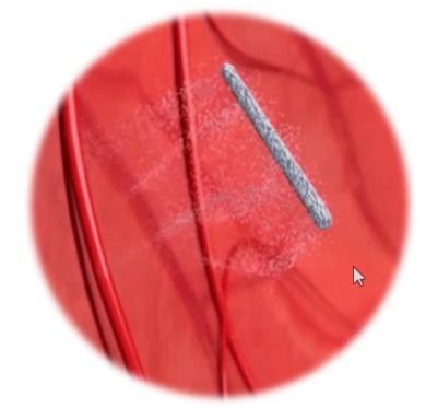 Geographic Atrophy, GA